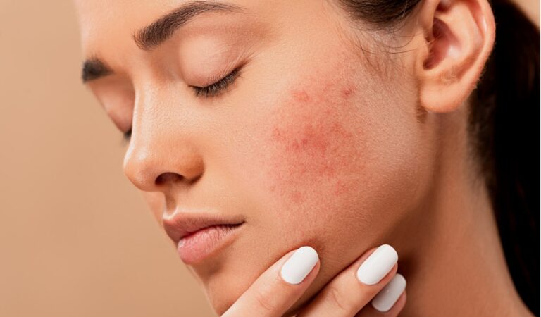 How to Deal With Your Blemishes: Tips for Clear, Glowing Skin!